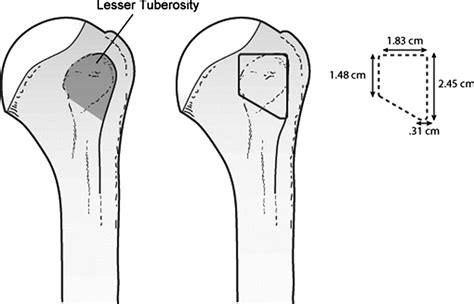 hermes subscapolare|The Subscapularis Footprint: An Anatomic Description of.